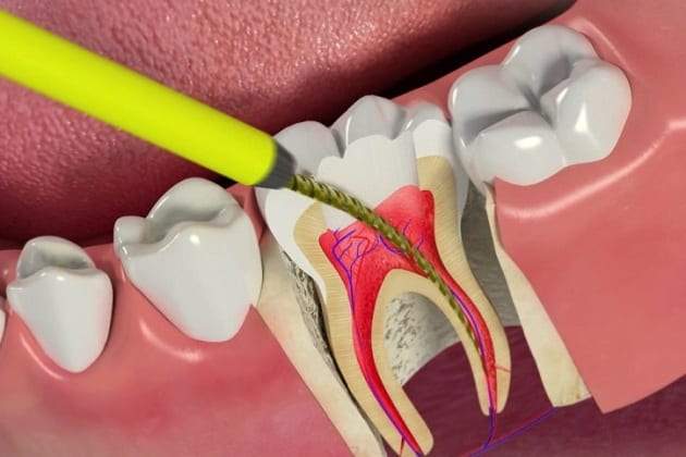 endodoncia en guayaquil