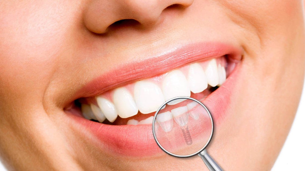 implante dental en Guayaquil