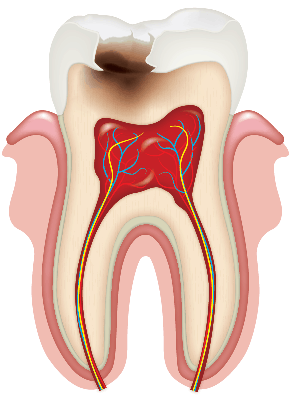 Curacion de Caries