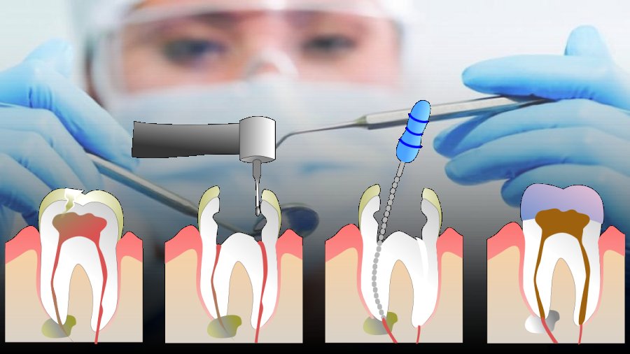 Endodoncia