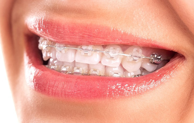 Brackets Esteticos en Guayaquil