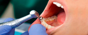 Profilaxis y limpieza dental en Guayaquil